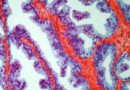 Estudio identifica una posible estrategia de inmunoterapia para el cáncer de próstata en estadio inicial