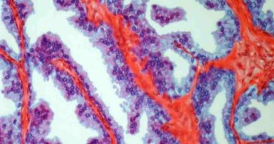 Estudio identifica una posible estrategia de inmunoterapia para el cáncer de próstata en estadio inicial
