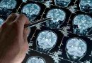 ¿A qué edad comienza la enfermedad de Alzheimer? 