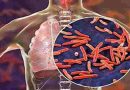 Dato alarmante: Aumentaron un 38% los casos de tuberculosis en Argentina