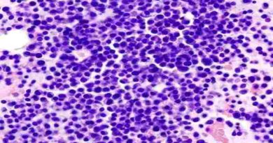 Cuál es la nueva opción de tratamiento para pacientes con mieloma múltiple aprobada por la ANMAT