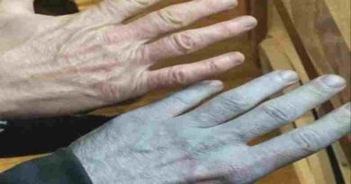 ¿Se convirtió en pitufo? Un hombre despertó completamente azul y terminó en urgencias