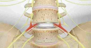La IA, la robótica y los implantes que preservan el movimiento amplían las opciones de cirugía de columna para los pacientes