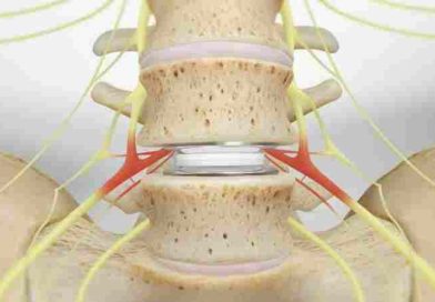 La IA, la robótica y los implantes que preservan el movimiento amplían las opciones de cirugía de columna para los pacientes