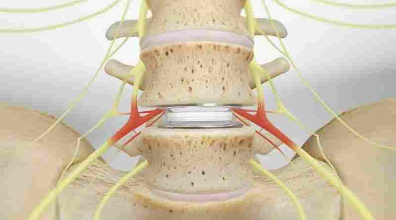 La IA, la robótica y los implantes que preservan el movimiento amplían las opciones de cirugía de columna para los pacientes