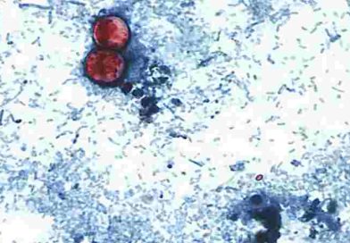 Estados Unidos: reportan las primeras dos muertes por brote de ciclosporiasis