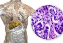 Cinco subtipos de enfermedad hepática común descubiertos, incluidas formas genéticas de rápida progresión