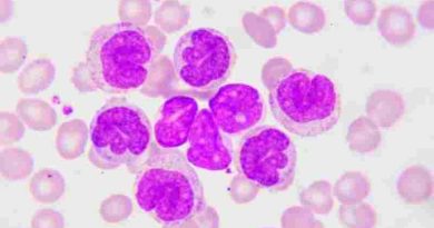 Leucemia linfocítica crónica: 9 de cada 10 pacientes no reconocen los síntomas antes del diagnóstico