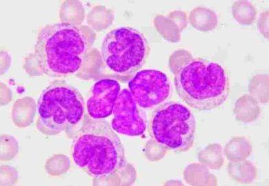 Leucemia linfocítica crónica: 9 de cada 10 pacientes no reconocen los síntomas antes del diagnóstico