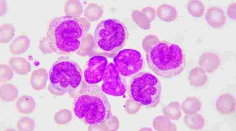 Leucemia linfocítica crónica: 9 de cada 10 pacientes no reconocen los síntomas antes del diagnóstico